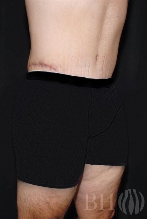 Body Lift Before & After