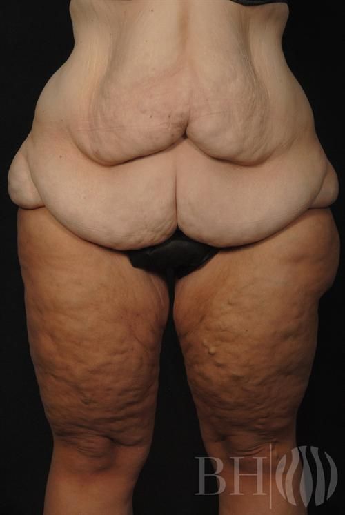 Body Lift Before & After