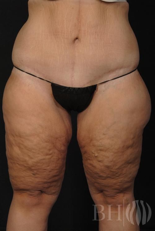 Body Lift Before & After