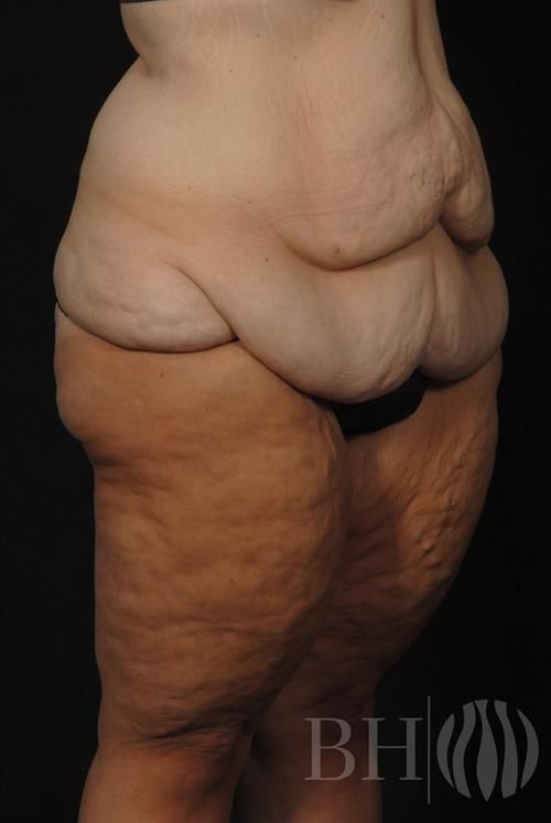 Body Lift Before & After