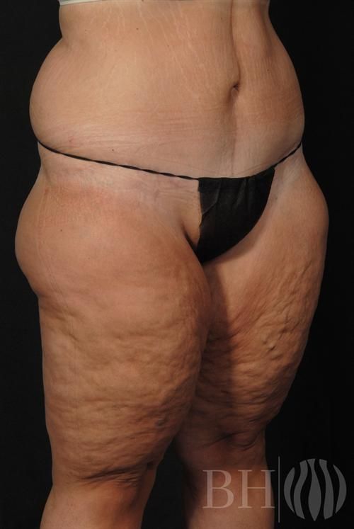 Body Lift Before & After