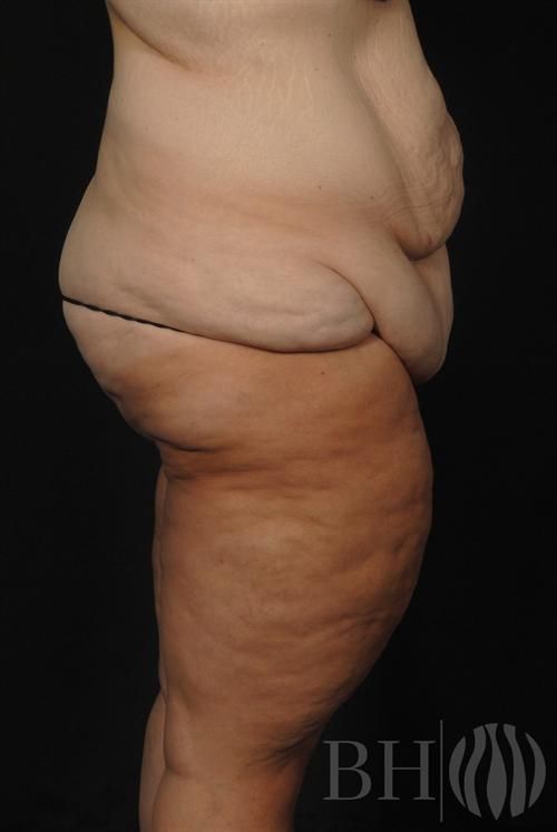 Body Lift Before & After