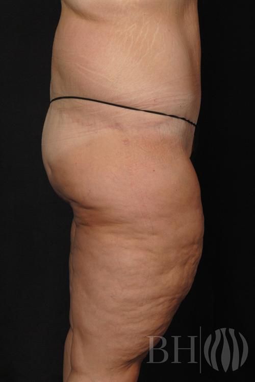 Body Lift Before & After