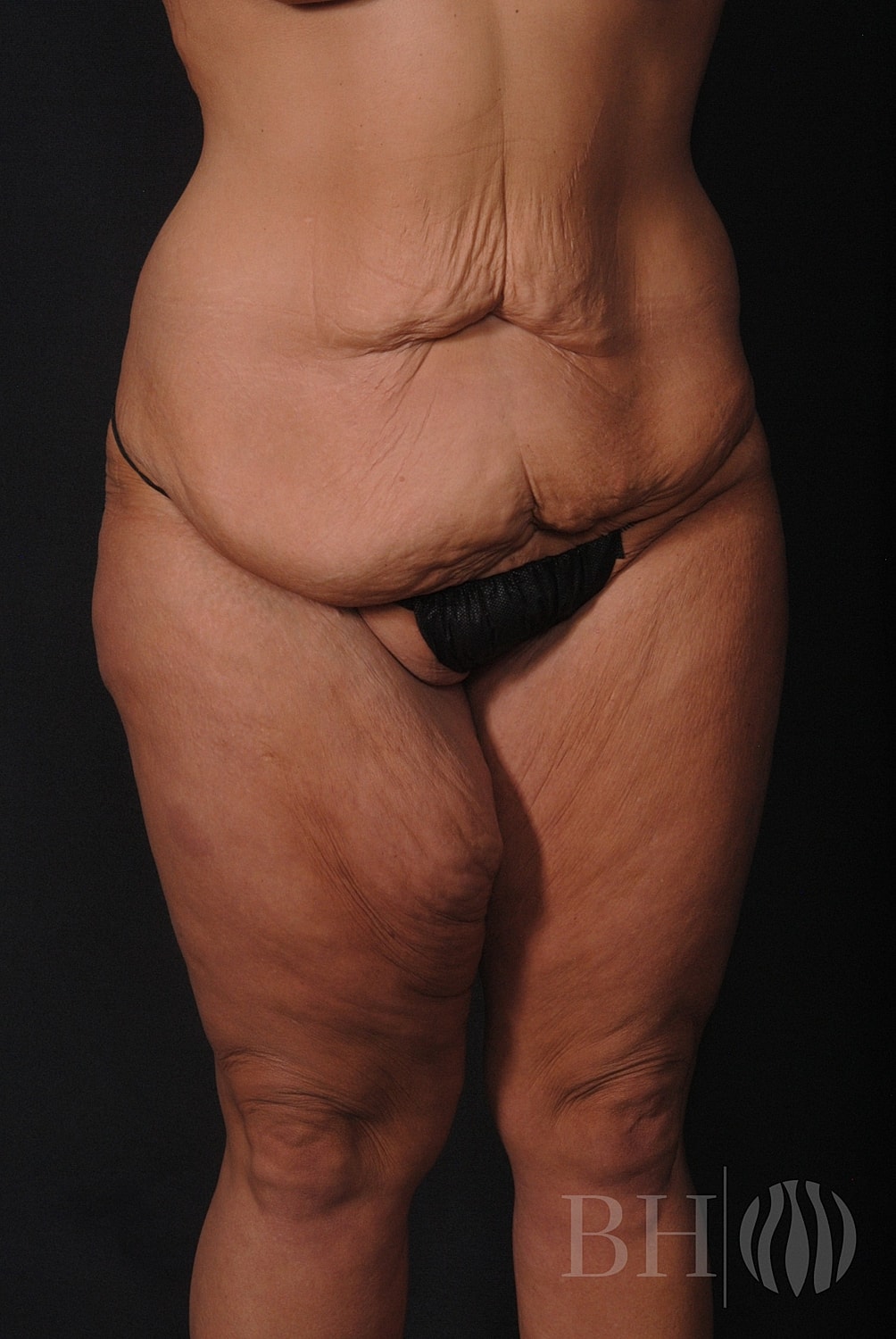 Body Lift Before & After