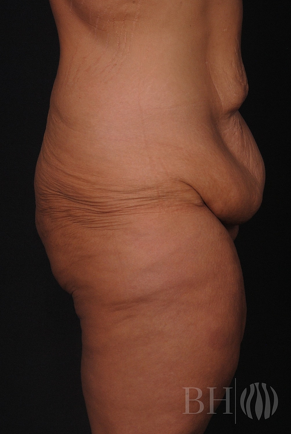 Body Lift Before & After