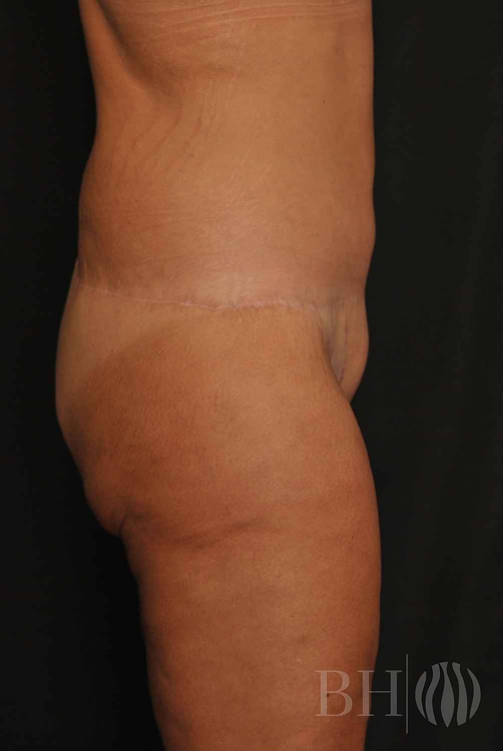 Body Lift Before & After