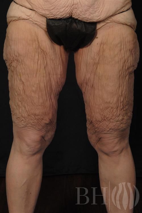 Thigh Lift Before & After