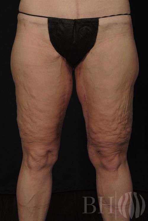 Thigh Lift Before & After