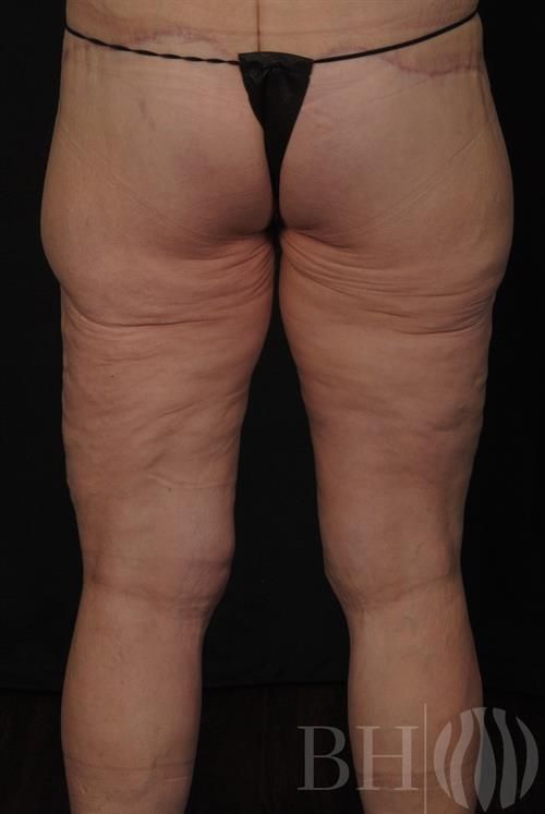 Thigh Lift Before & After