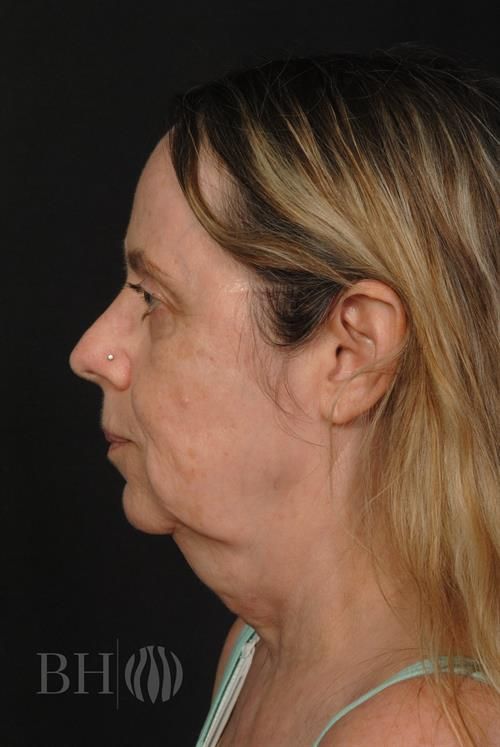 Facelift Before & After