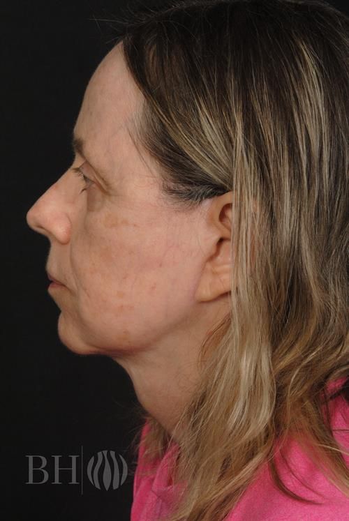 Facelift Before & After