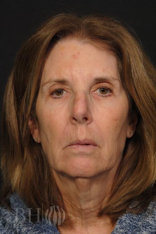 Facelift Before & After