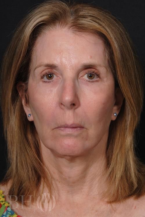Facelift Before & After
