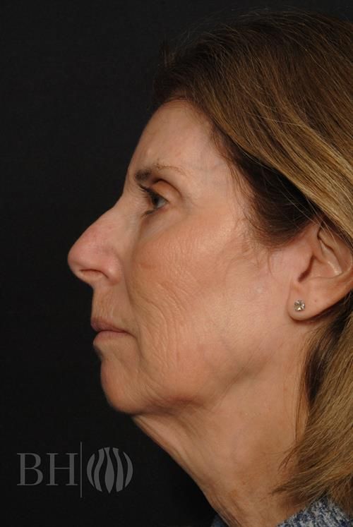 Facelift Before & After
