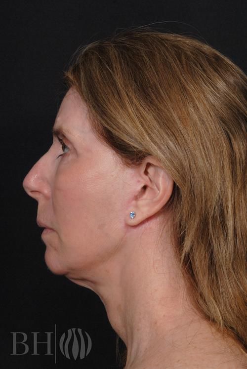 Facelift Before & After