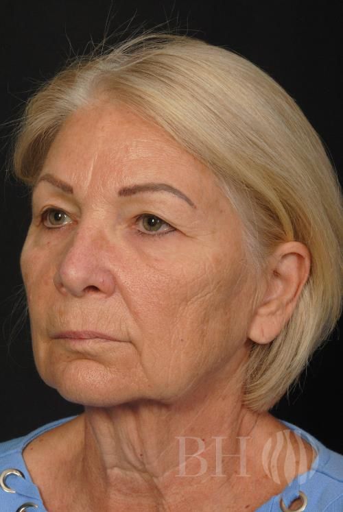 Facelift Before & After