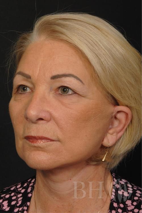 Facelift Before & After