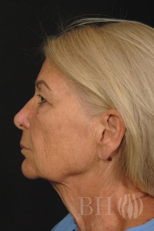 Facelift Before & After
