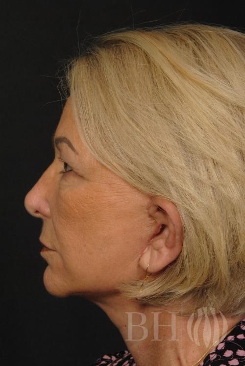 Facelift Before & After