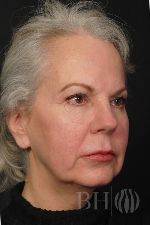 Facelift Before & After