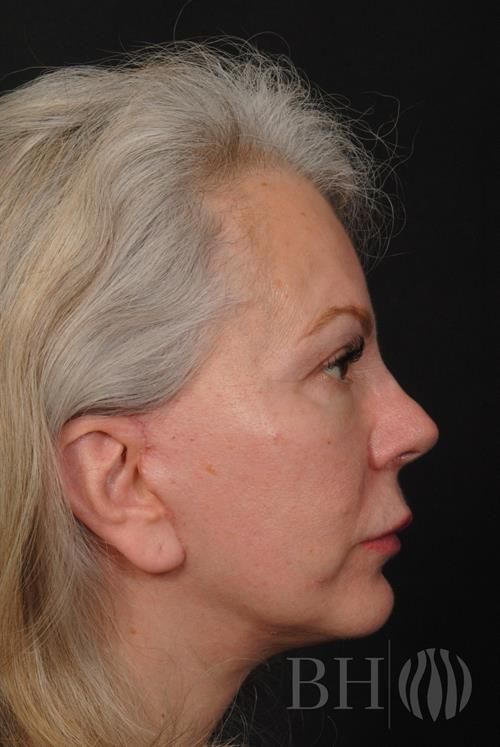 Facelift Before & After