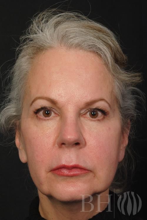 Facelift Before & After