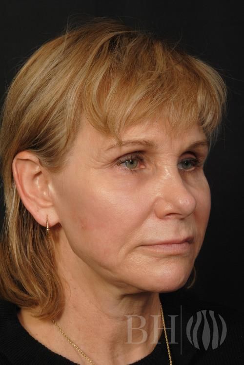 Facelift Before & After