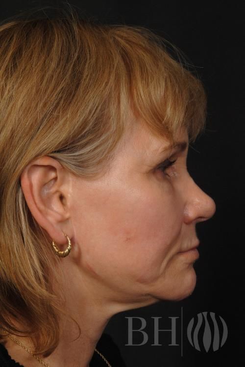 Facelift Before & After