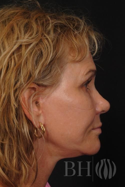 Facelift Before & After