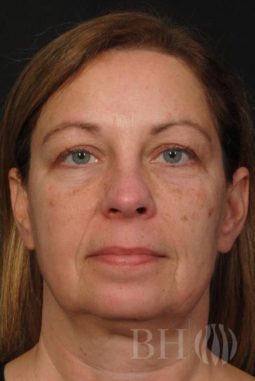 Facelift Before & After