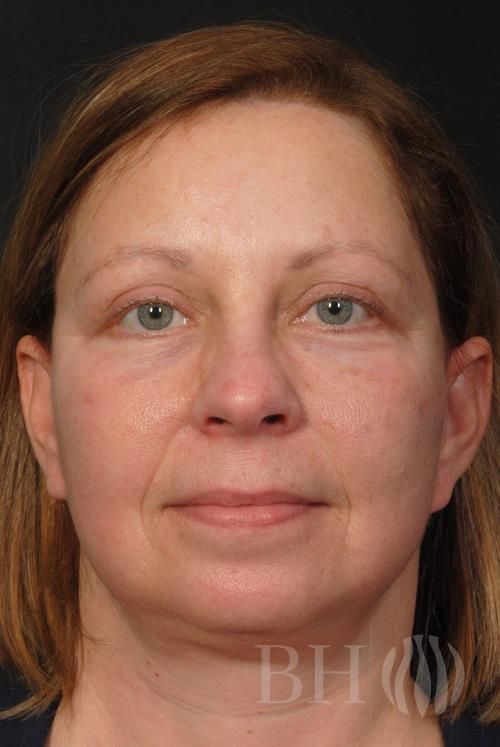 Facelift Before & After