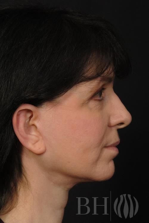 Facelift Before & After