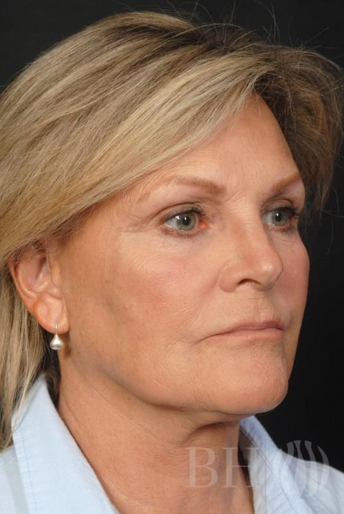 Facelift Before & After