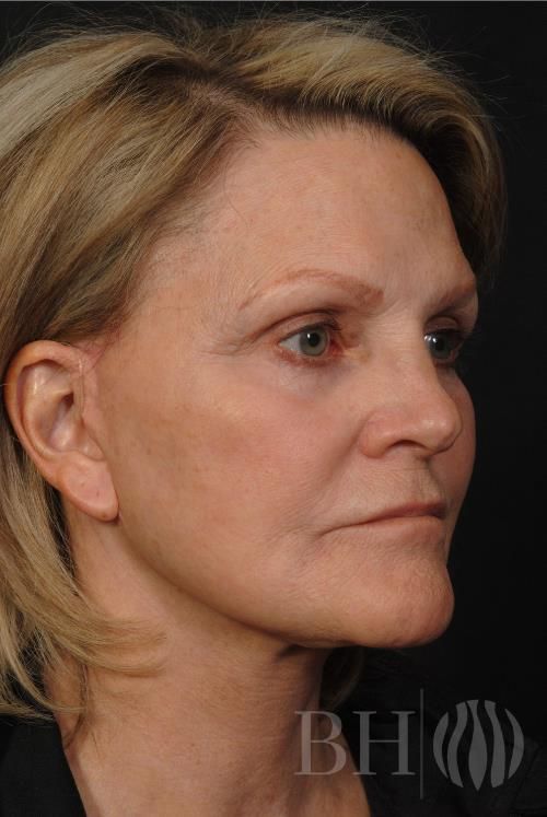 Facelift Before & After