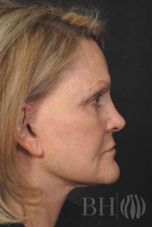 Facelift Before & After