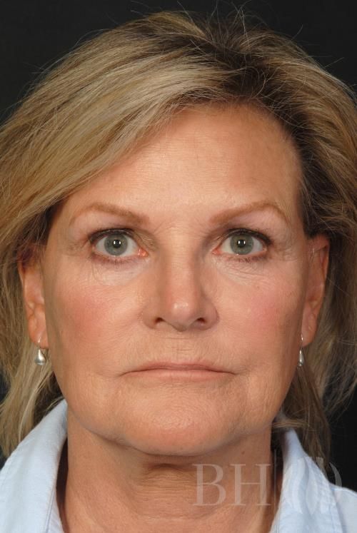 Facelift Before & After