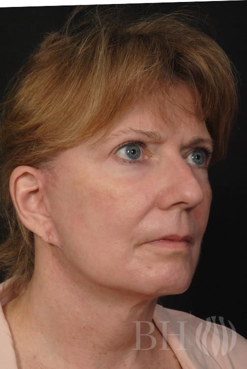 Facelift Before & After