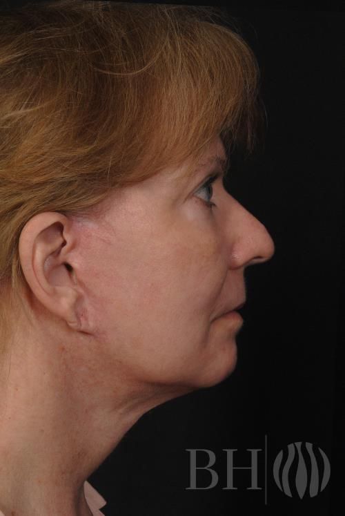 Facelift Before & After