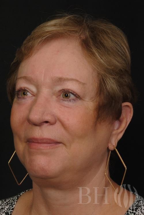 Facelift Before & After