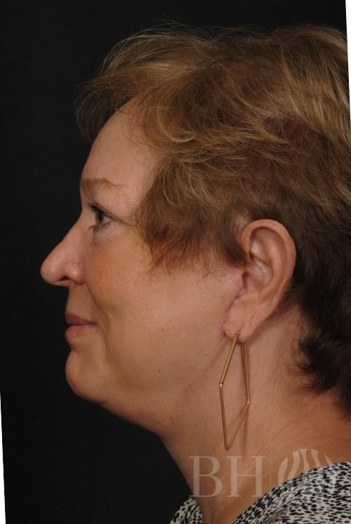 Facelift Before & After