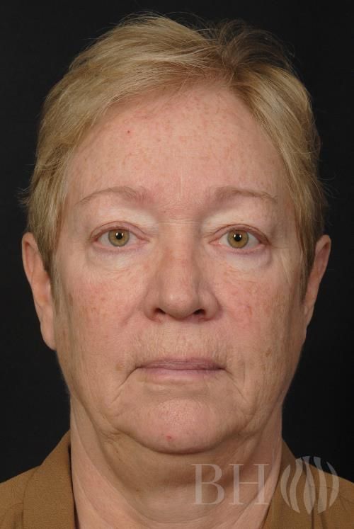 Facelift Before & After