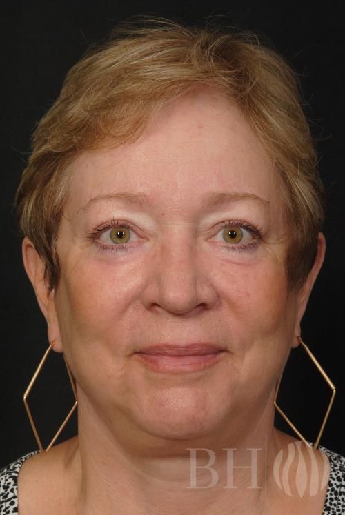 Facelift Before & After