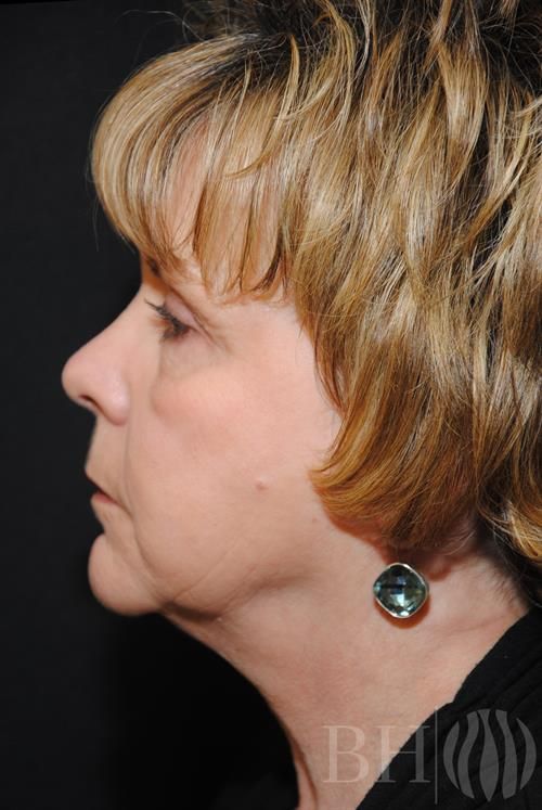 Facelift Before & After