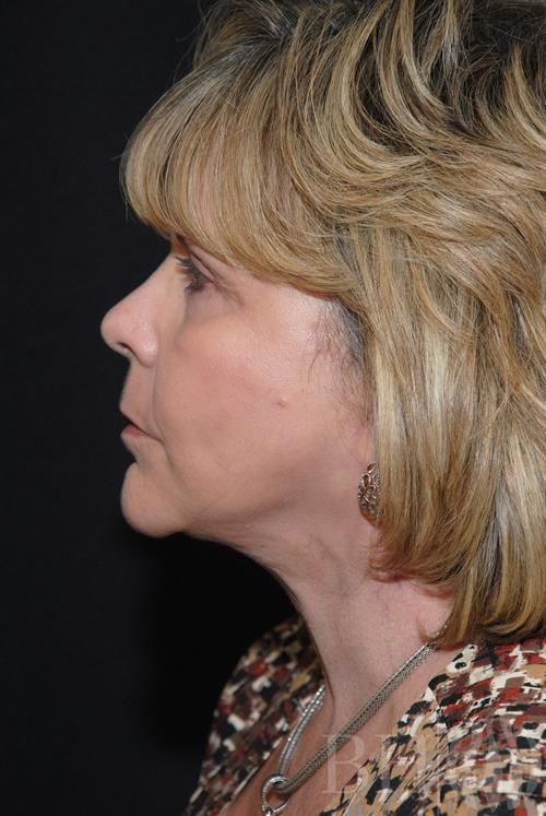 Facelift Before & After