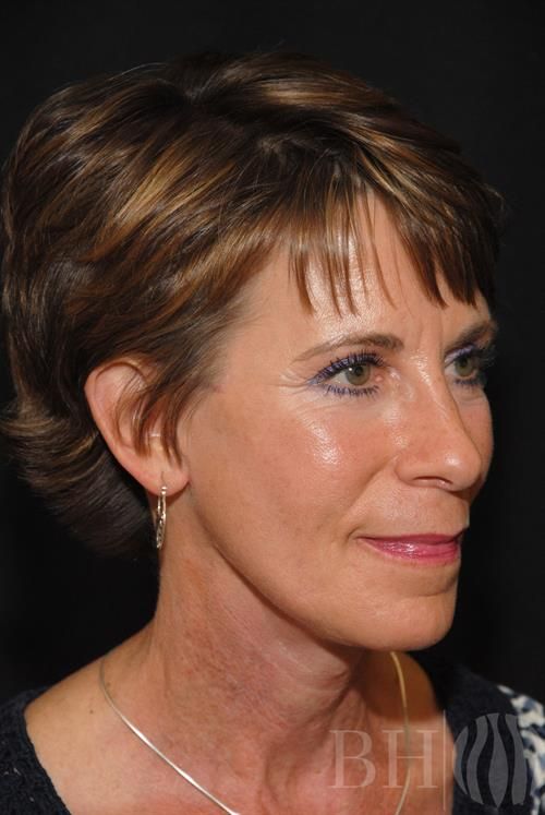 Facelift Before & After