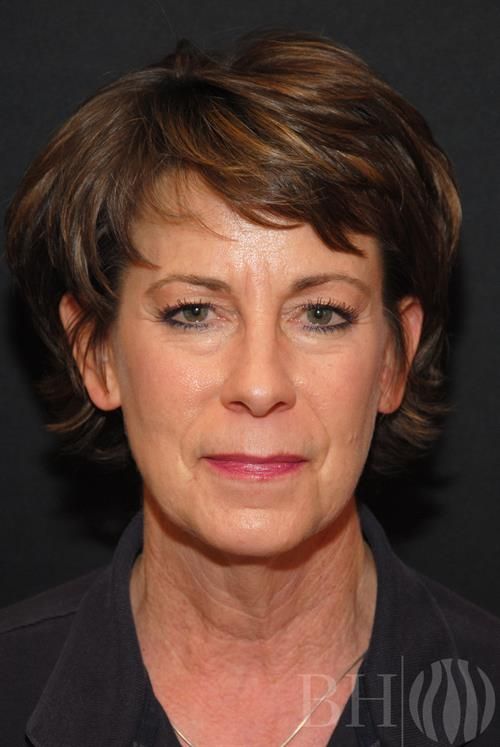 Facelift Before & After