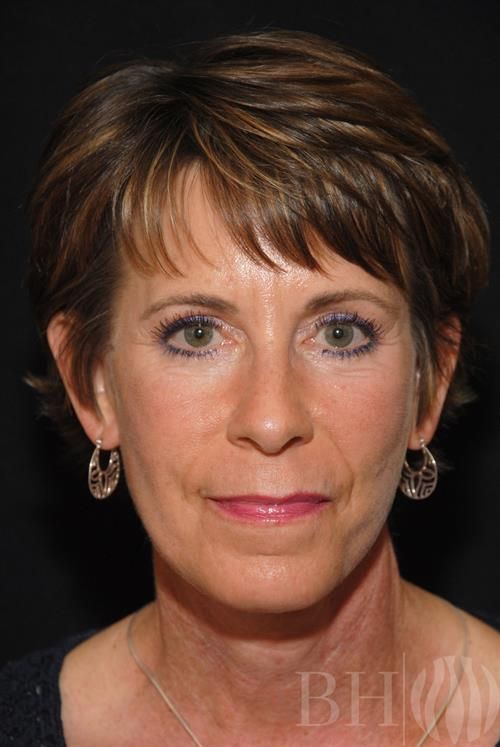 Facelift Before & After