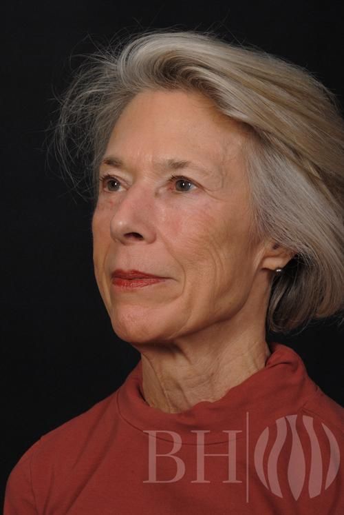 Facelift Before & After