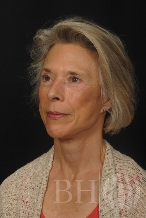 Facelift Before & After