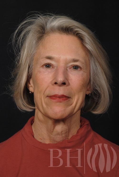 Facelift Before & After